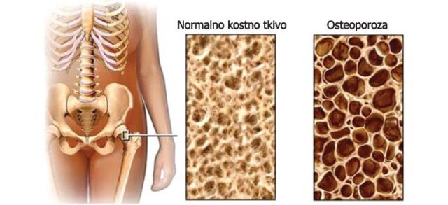 OBELEŽAVANjE SVETSKOG DANA BORBE PROTIV OSTEROPOROZE