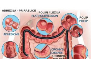 Poliklinika Life IMPULS – Snimanje debelog creva – Kolonoskopija