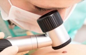 U lečenju melanoma najvažnije je otkriti ga na vreme