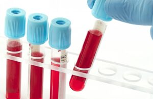 Dom zdravlja organizuje akcije laboratorijske dijagnostike po niškim selima Laboratorijske dijagnostike