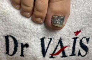Dr Vais rešavanje problema gljivične infekcije noktiju Gljivična infekcija noktiju