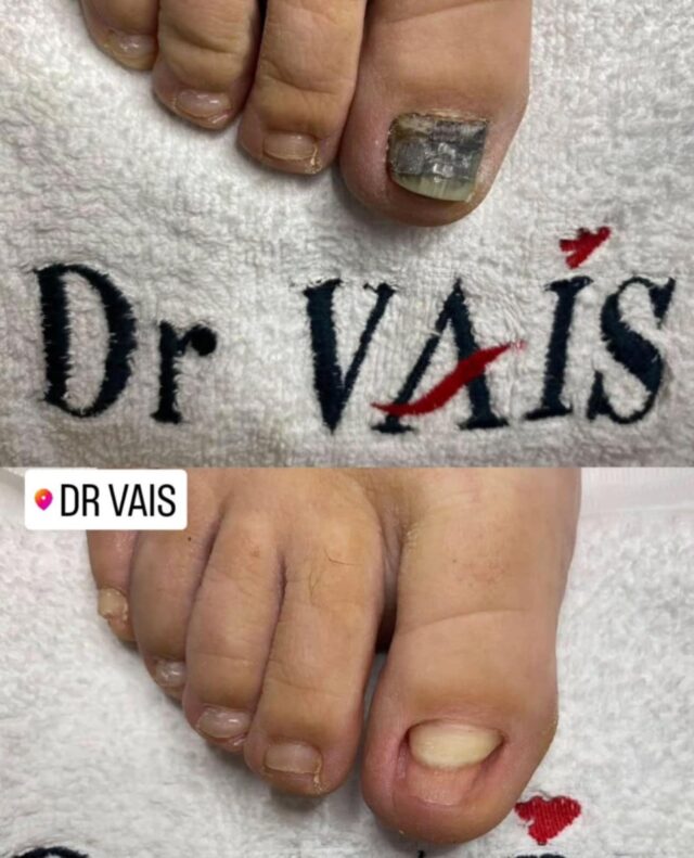 Gljivična infekcija noktiju